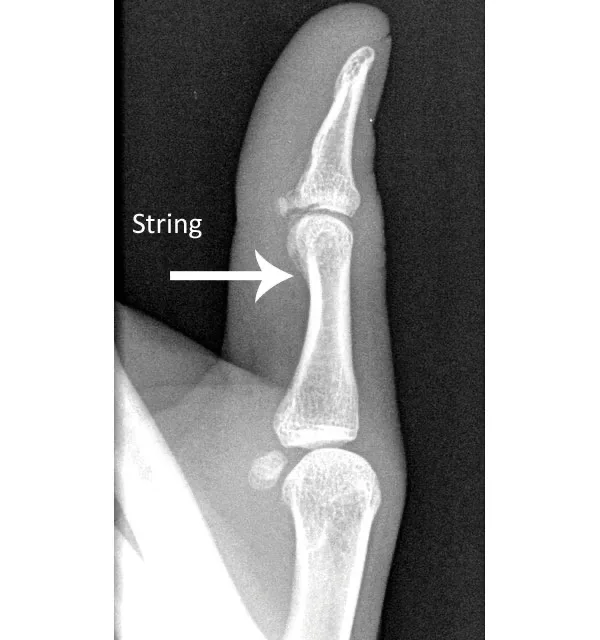 An x-ray image of a human finger shows a white arrow pointing to the middle joint, with the word 'String' written next to…