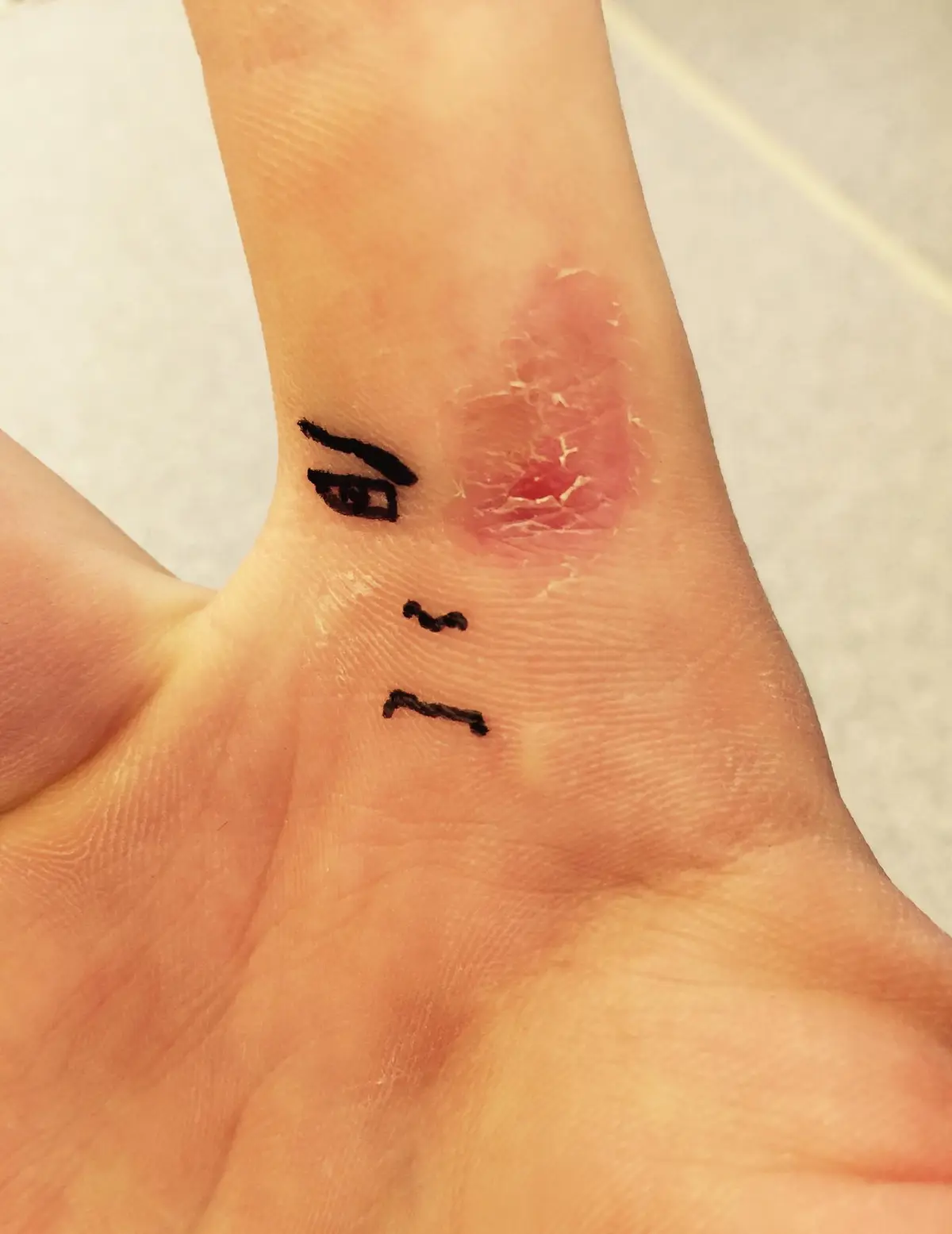 A close-up of a person's hand shows a red, irritated, and peeling skin patch on the wrist, which has been humorously drawn…